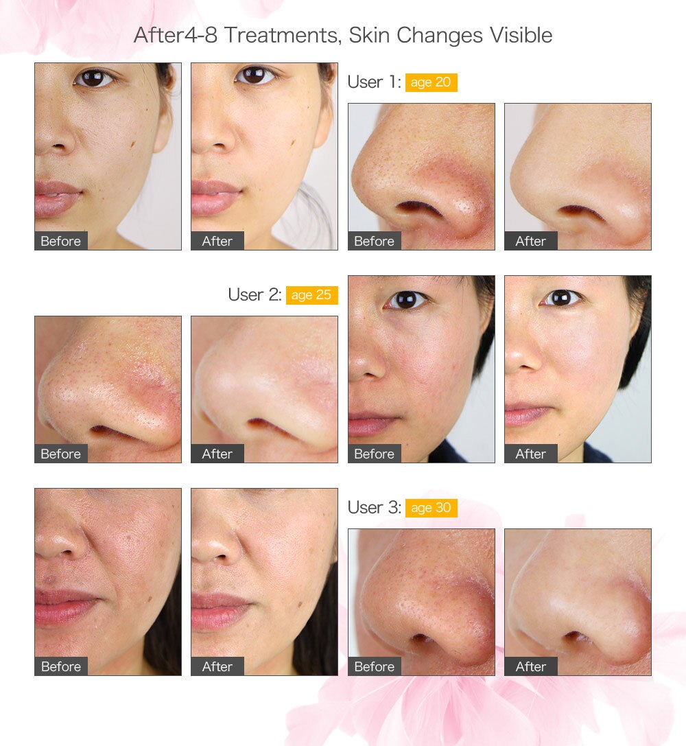 Face Peeing Vacuum Skin Care Blackhead Removal Machine